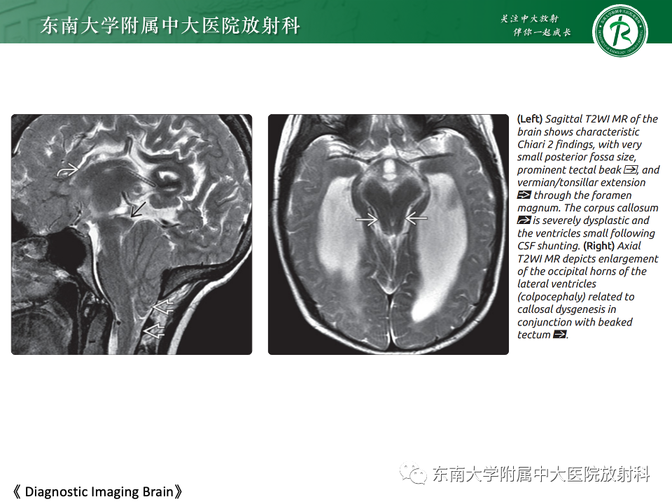 【PPT】小脑扁桃体下疝畸形-14