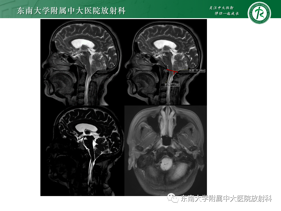 【PPT】小脑扁桃体下疝畸形-3