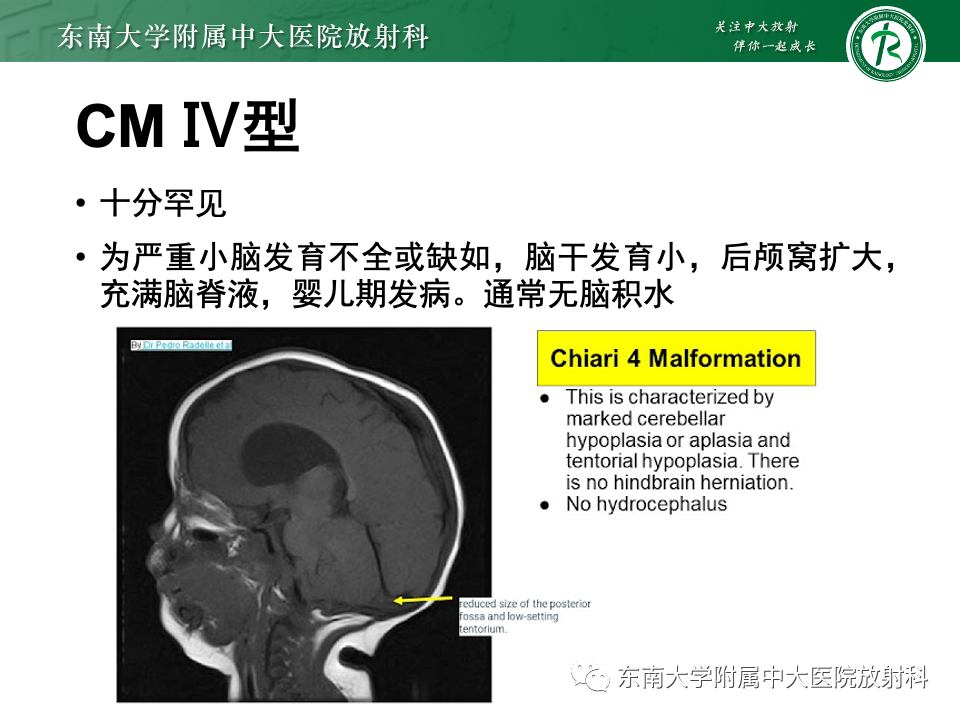 【PPT】小脑扁桃体下疝畸形-18