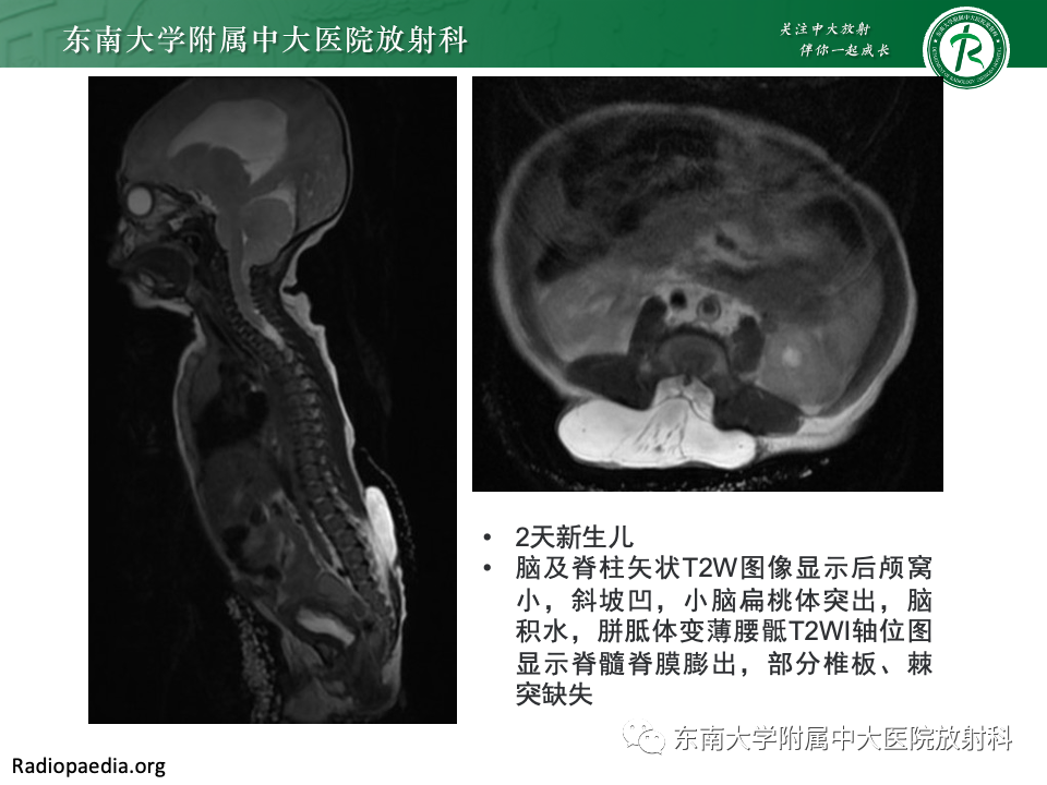 【PPT】小脑扁桃体下疝畸形-15