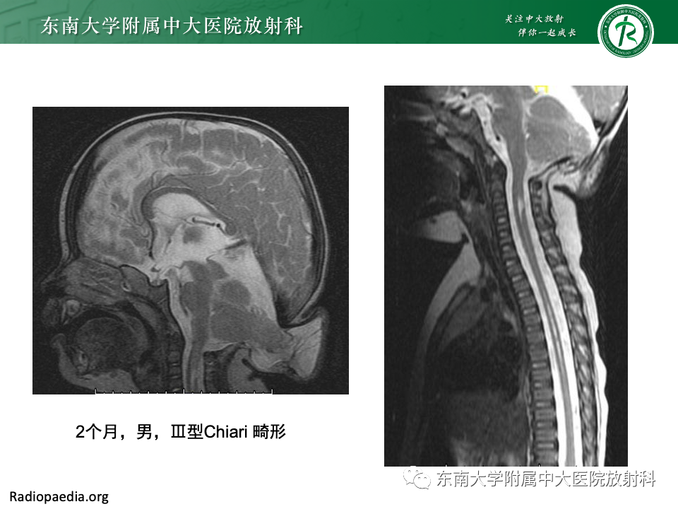 【PPT】小脑扁桃体下疝畸形-17