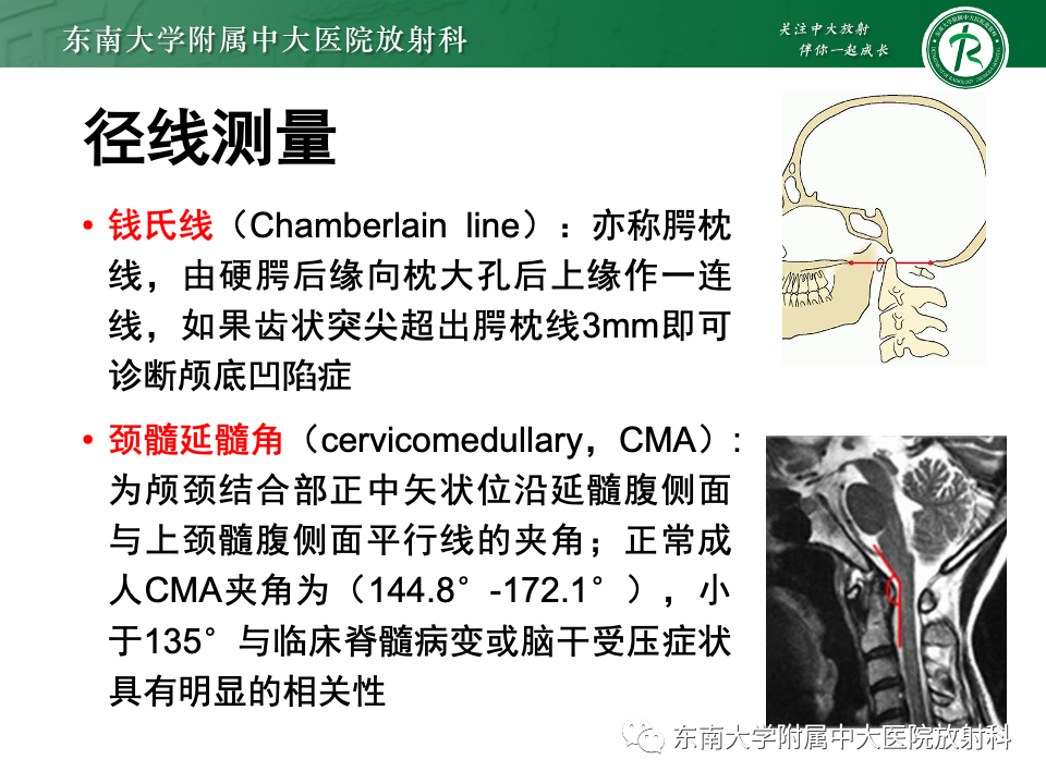 【PPT】小脑扁桃体下疝畸形-21