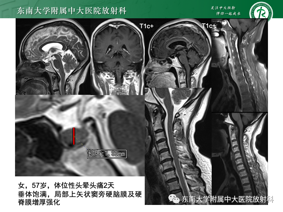【PPT】小脑扁桃体下疝畸形-27