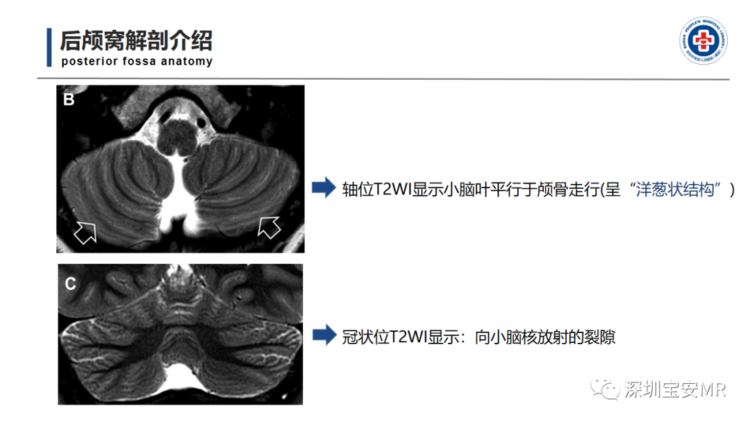 【PPT】后颅窝畸形-5