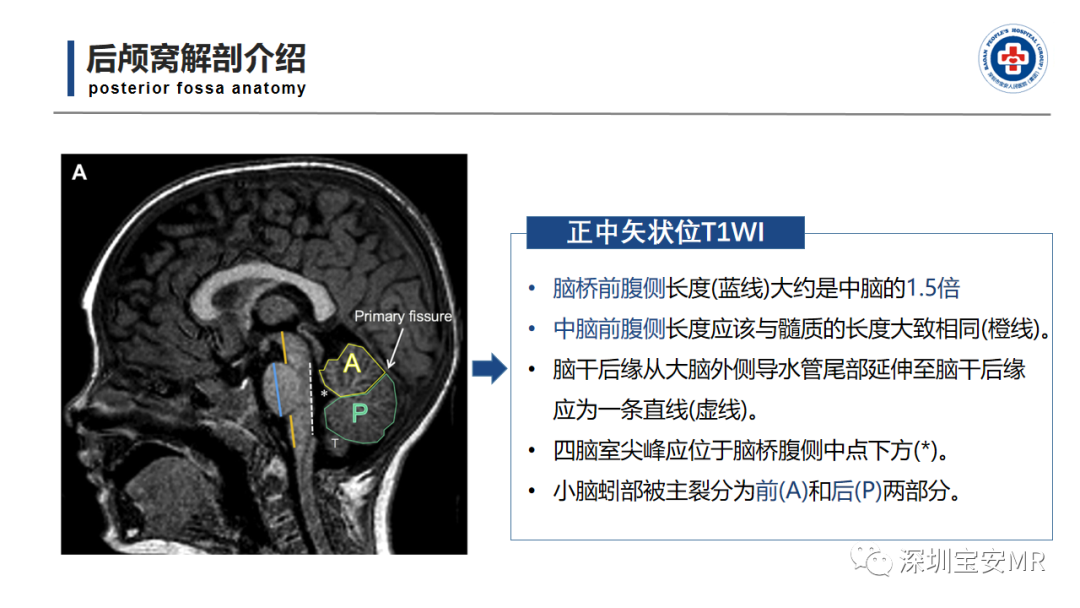 【PPT】后颅窝畸形-4
