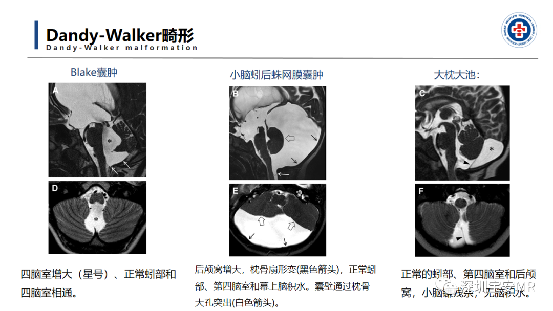 【PPT】后颅窝畸形-16