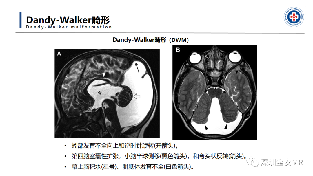 【PPT】后颅窝畸形-15