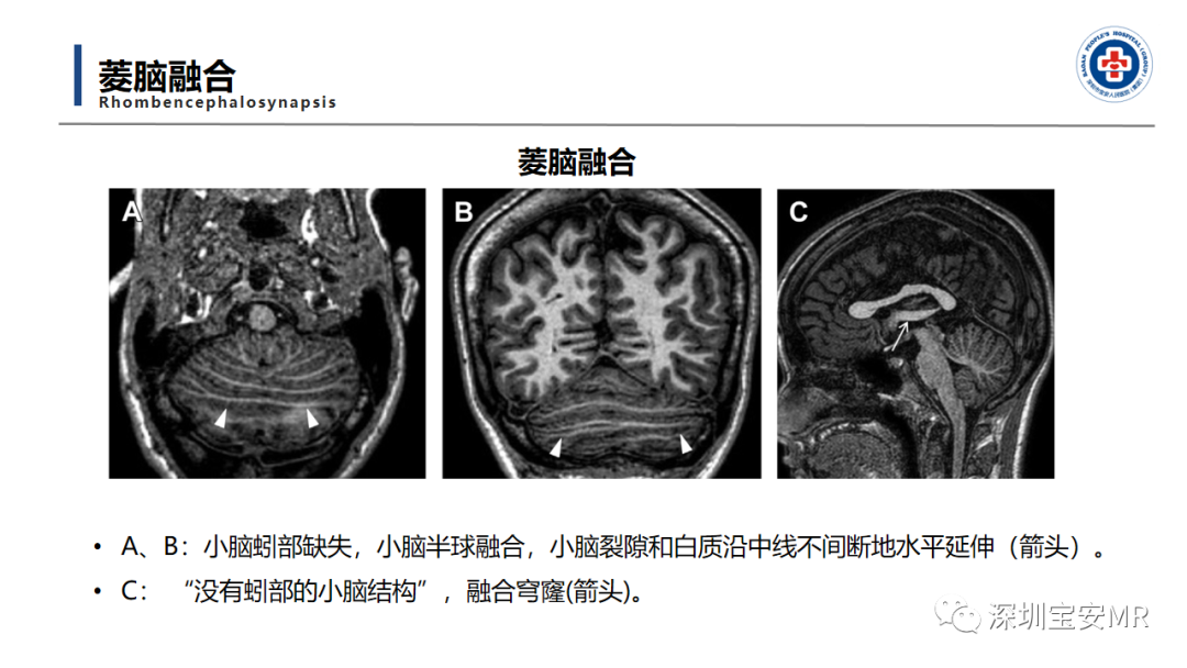【PPT】后颅窝畸形-20