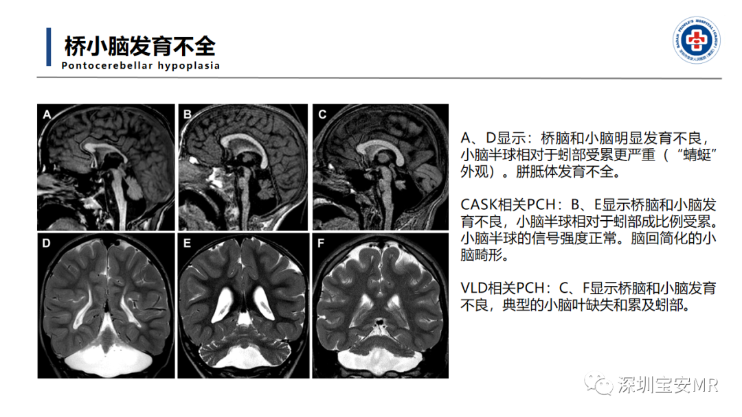 【PPT】后颅窝畸形-30