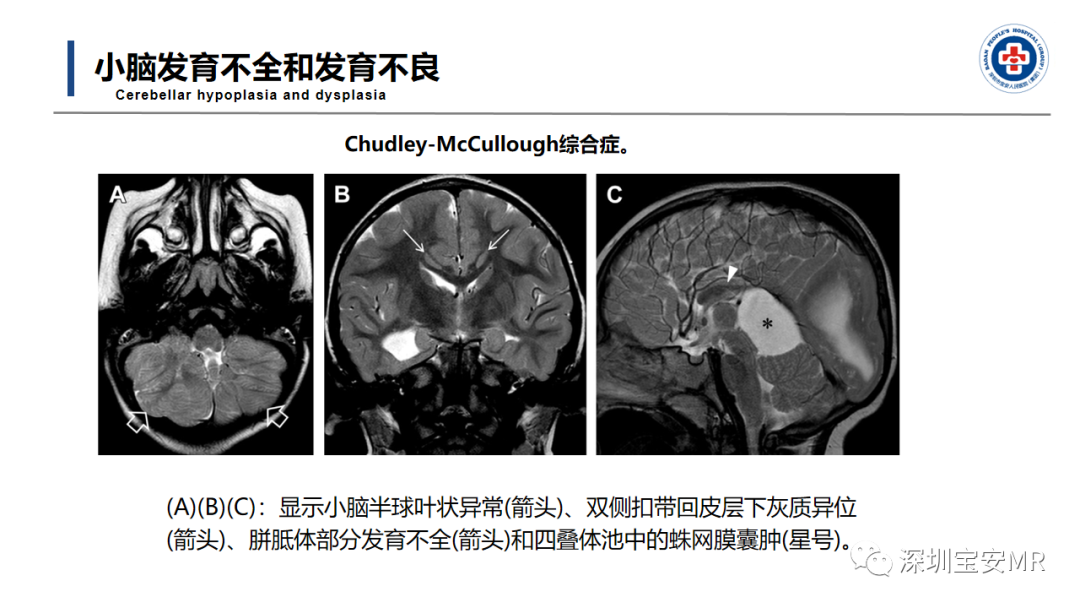 【PPT】后颅窝畸形-25