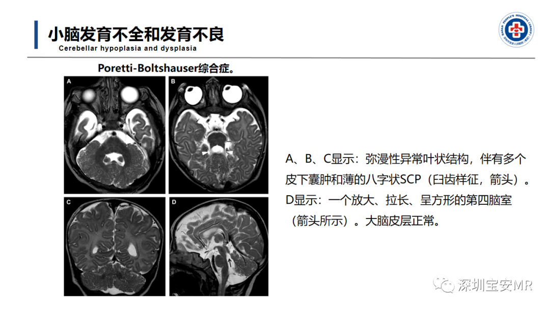 【PPT】后颅窝畸形-24