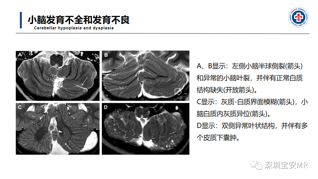 【PPT】后颅窝畸形-23