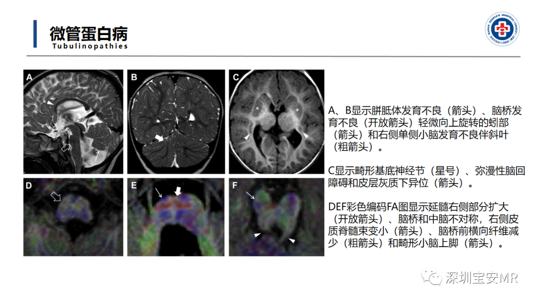 【PPT】后颅窝畸形-32