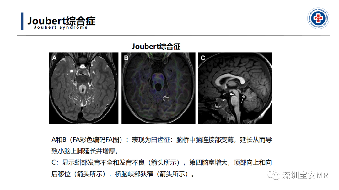 【PPT】后颅窝畸形-35