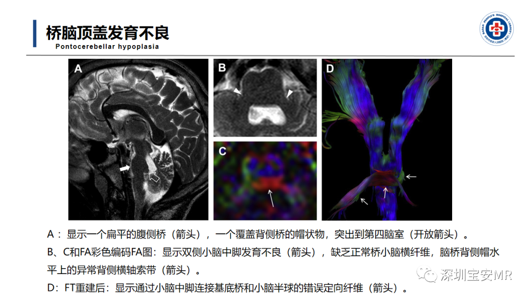 【PPT】后颅窝畸形-39