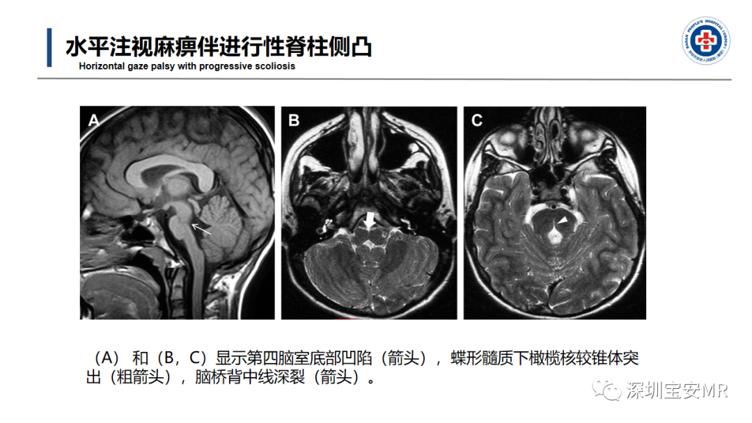 【PPT】后颅窝畸形-41