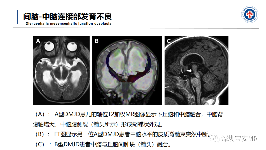 【PPT】后颅窝畸形-43