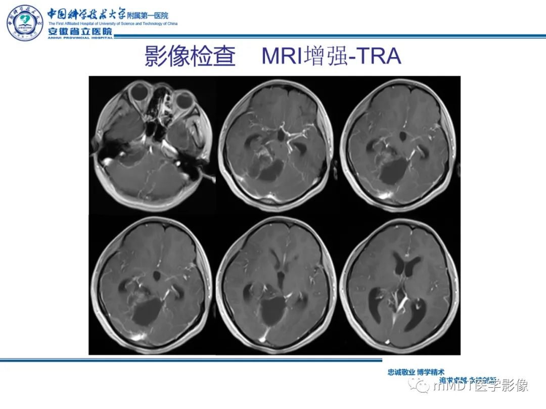 【PPT】毛细胞型星形细胞瘤病例解析-8