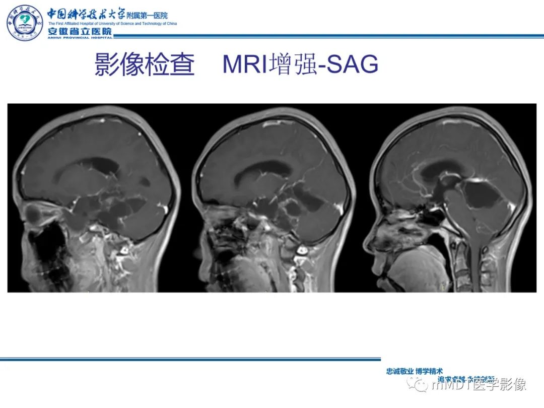 【PPT】毛细胞型星形细胞瘤病例解析-9