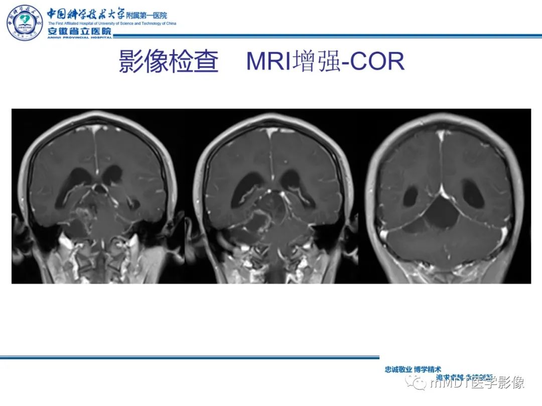 【PPT】毛细胞型星形细胞瘤病例解析-10