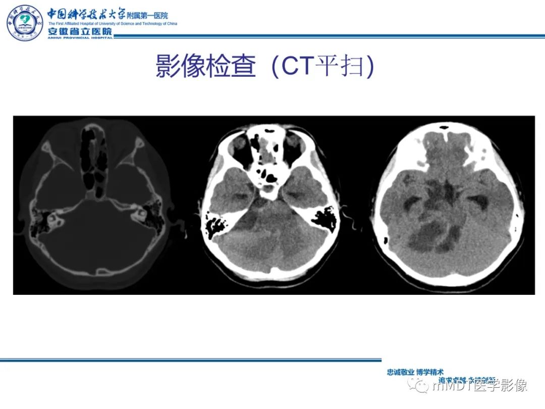 【PPT】毛细胞型星形细胞瘤病例解析-4