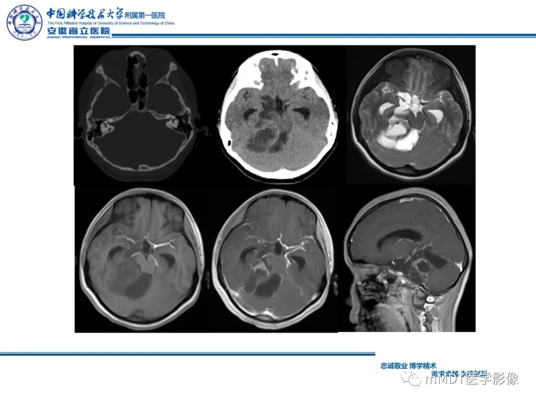 【PPT】毛细胞型星形细胞瘤病例解析-11
