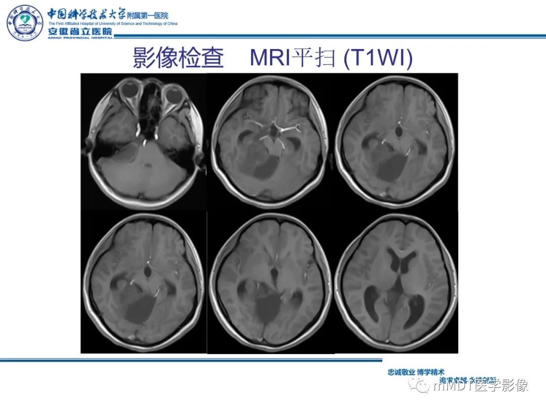 【PPT】毛细胞型星形细胞瘤病例解析-7