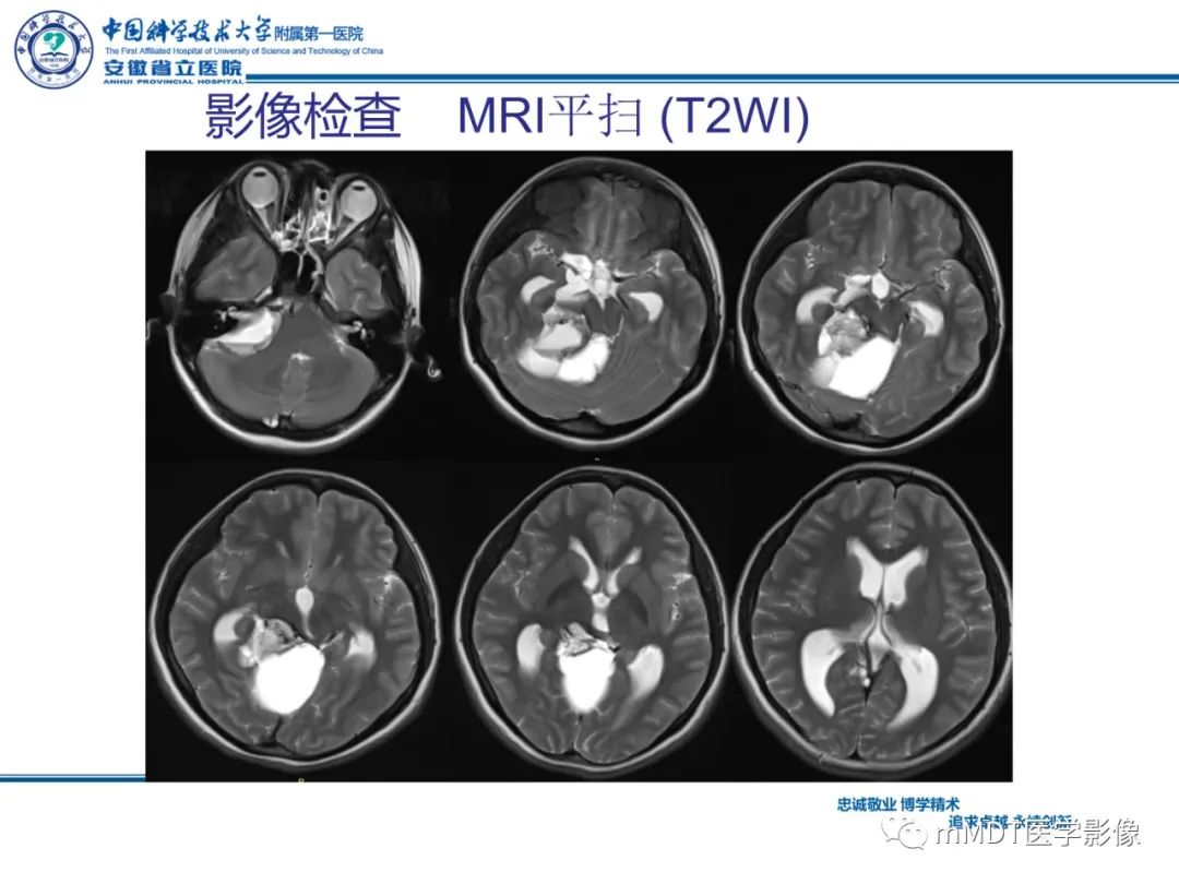 【PPT】毛细胞型星形细胞瘤病例解析-6