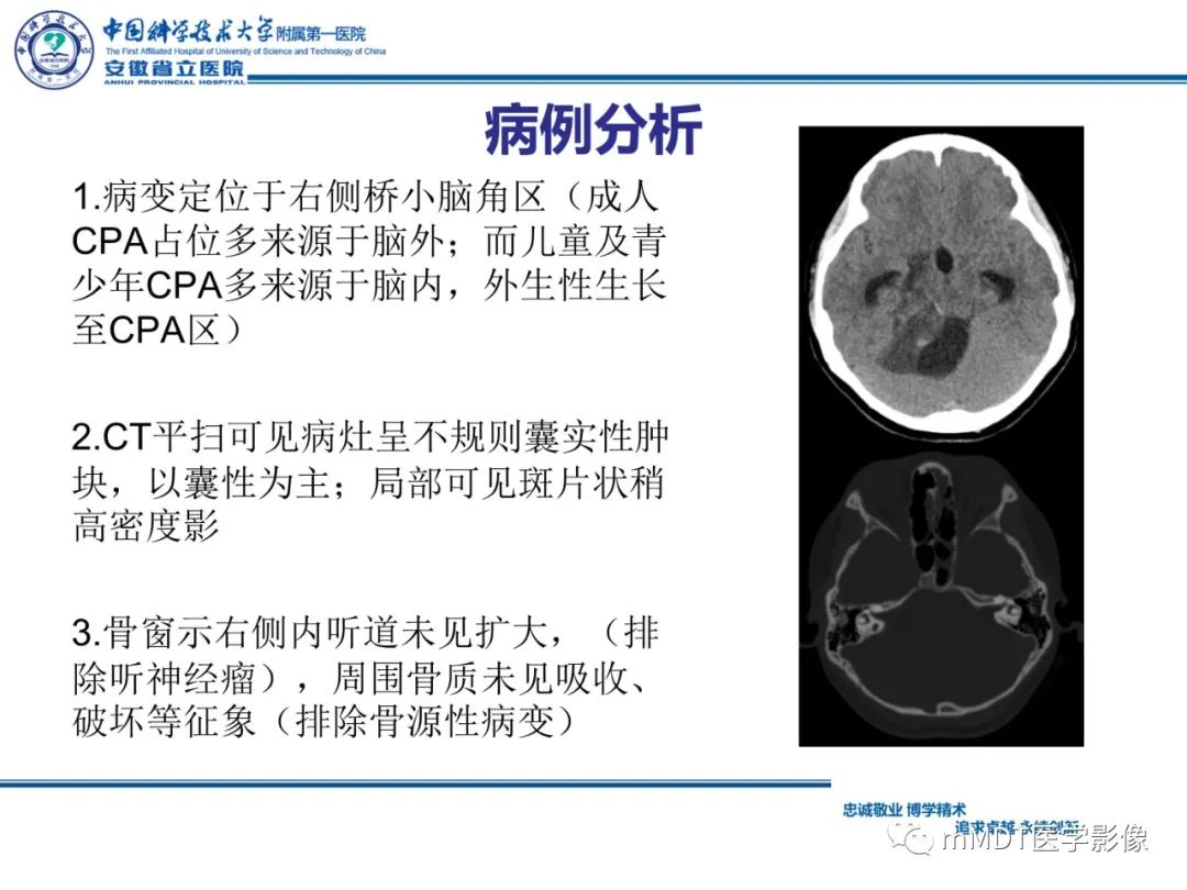 【PPT】毛细胞型星形细胞瘤病例解析-13