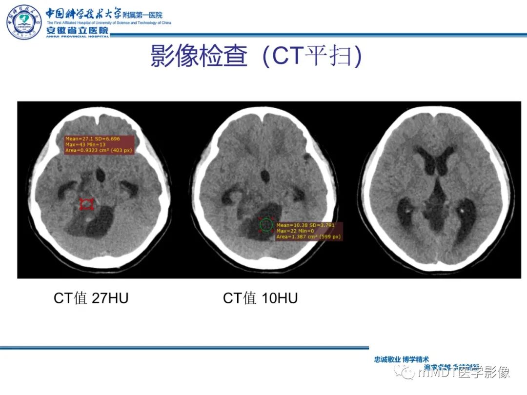 【PPT】毛细胞型星形细胞瘤病例解析-5