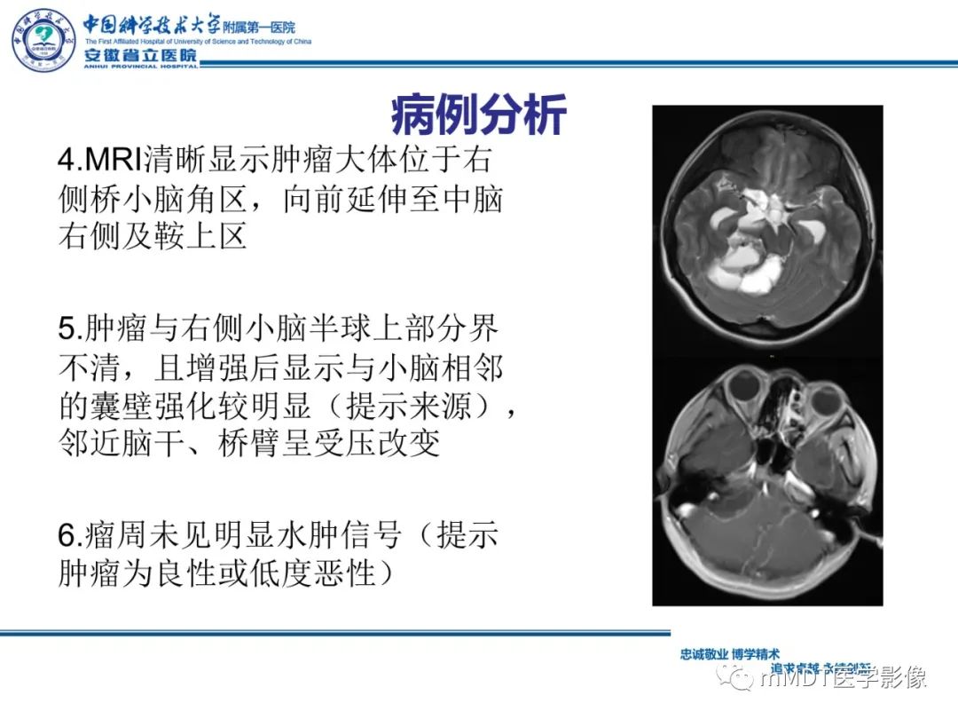 【PPT】毛细胞型星形细胞瘤病例解析-14