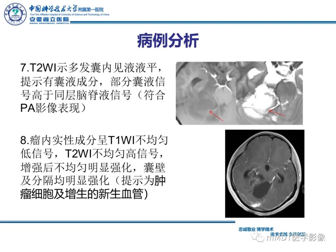 【PPT】毛细胞型星形细胞瘤病例解析-15