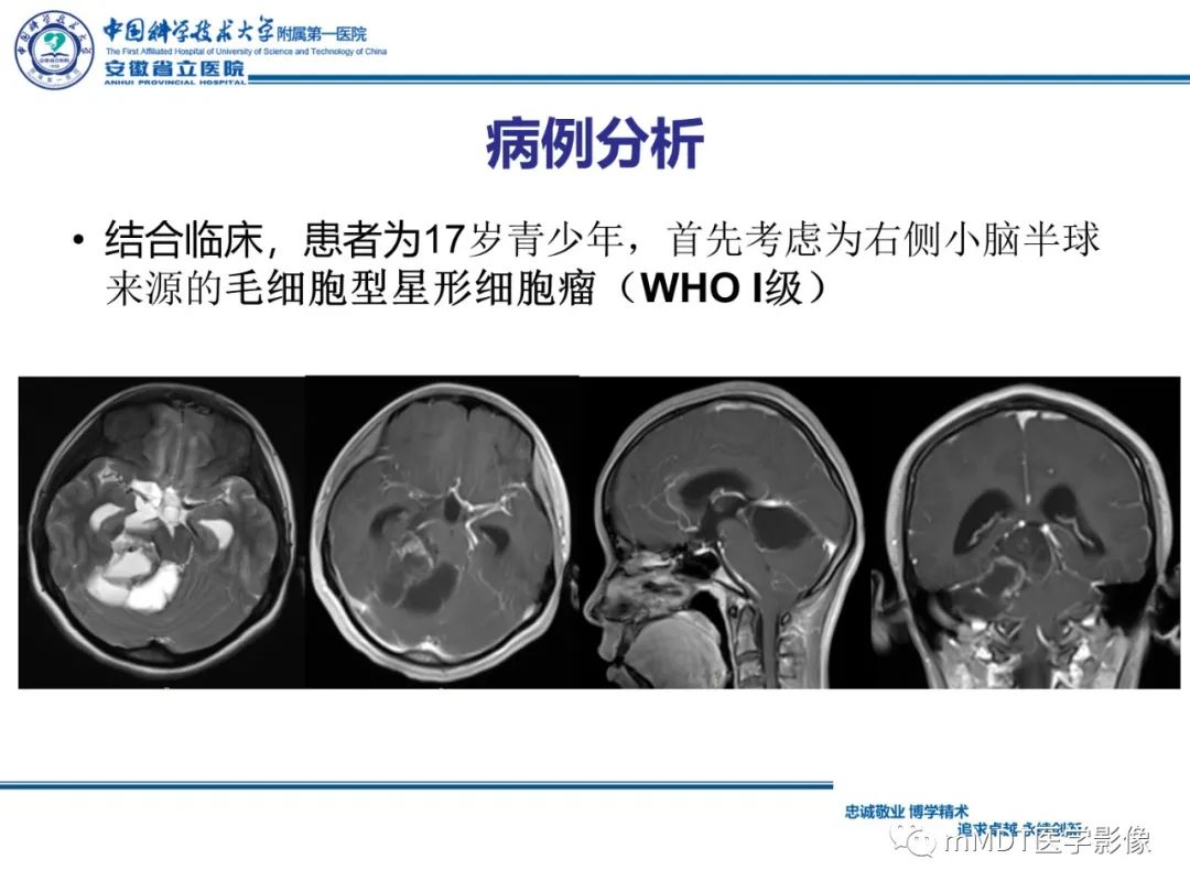 【PPT】毛细胞型星形细胞瘤病例解析-16