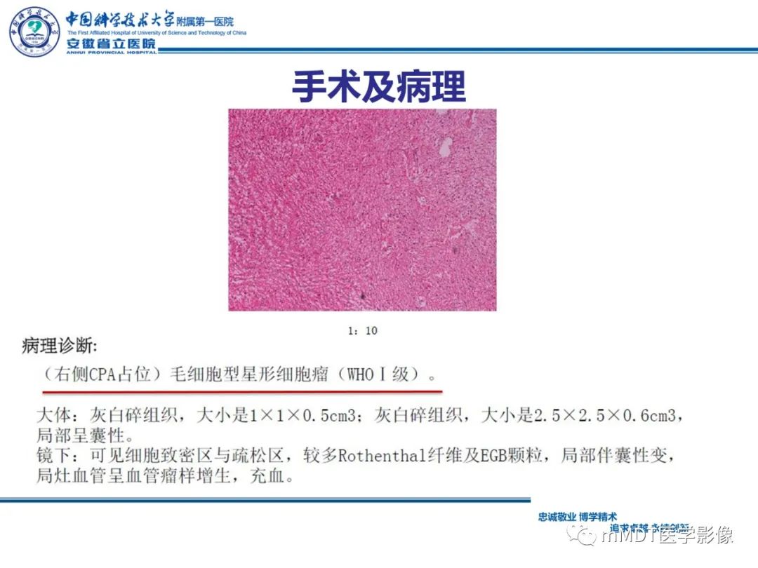 【PPT】毛细胞型星形细胞瘤病例解析-18