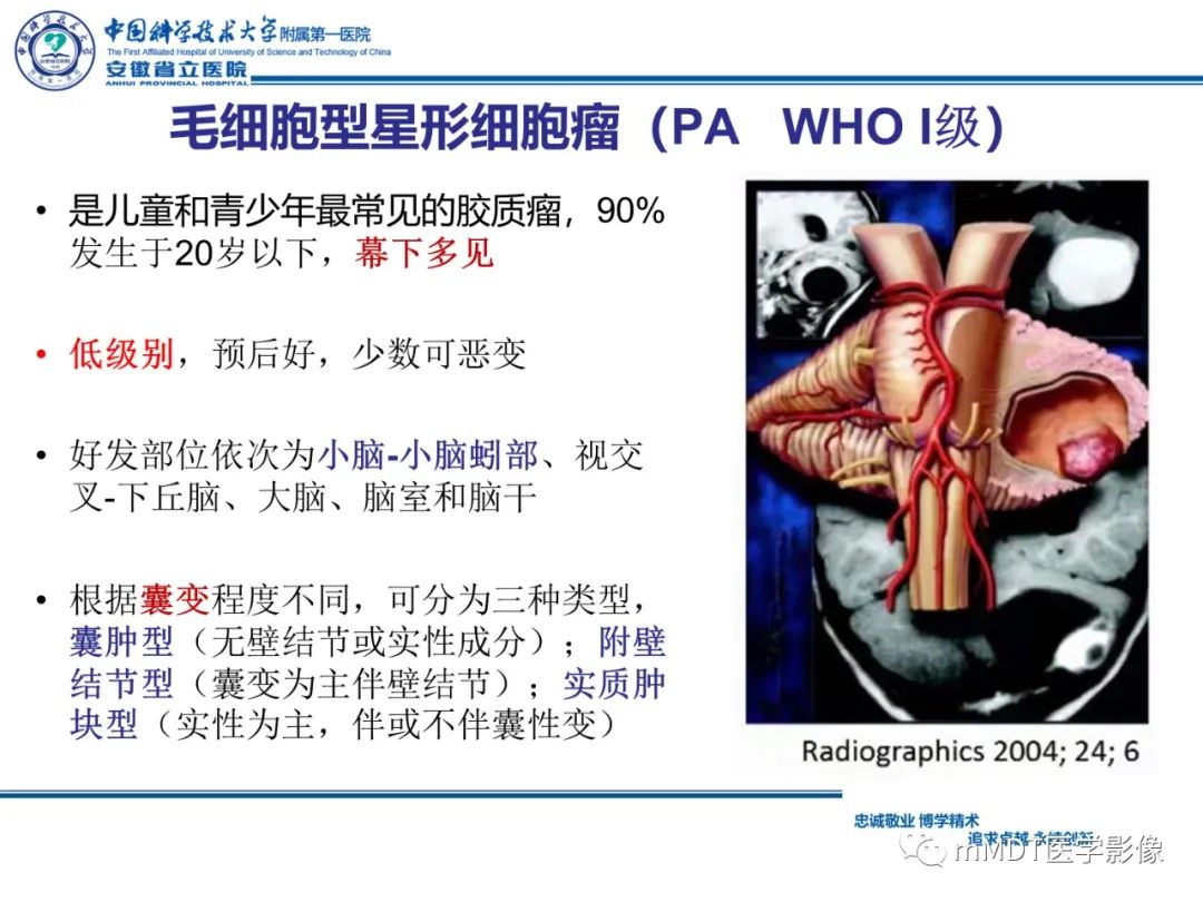 【PPT】毛细胞型星形细胞瘤病例解析-19