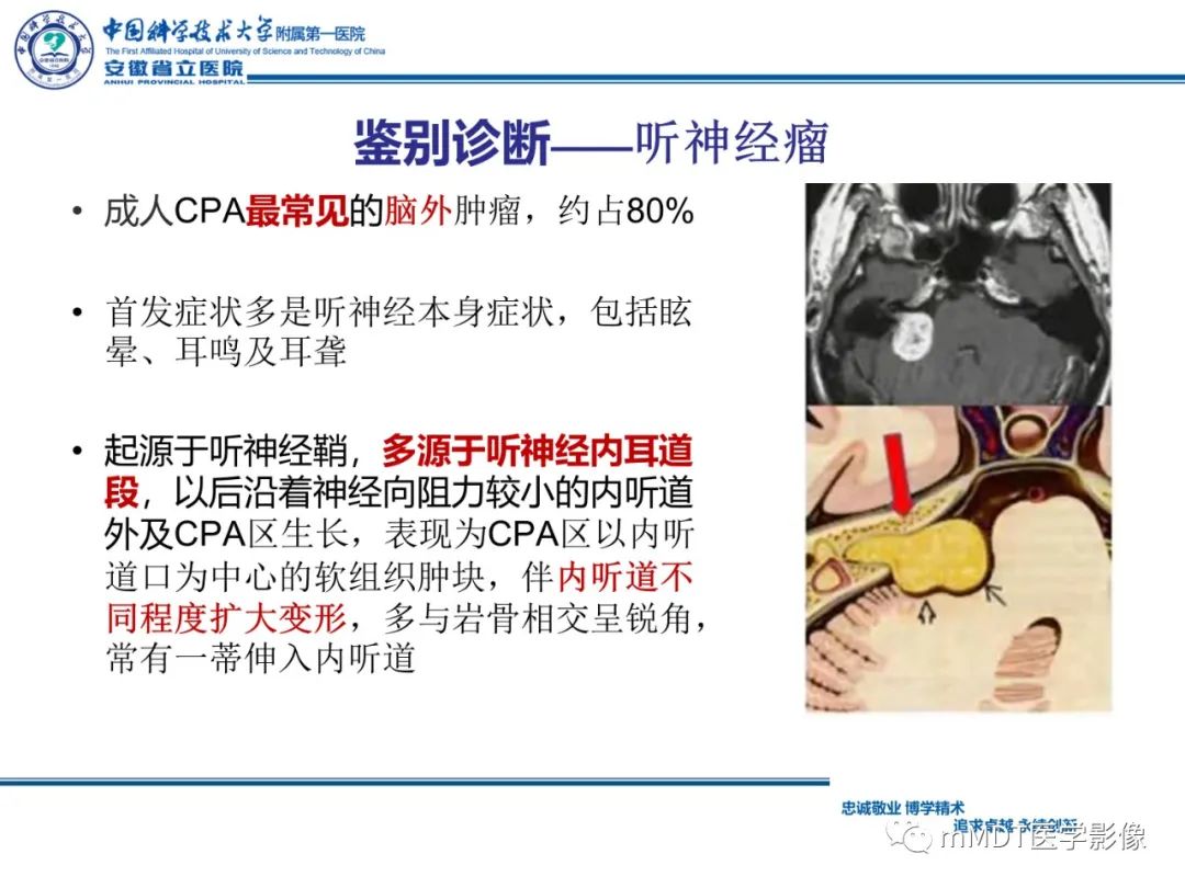 【PPT】毛细胞型星形细胞瘤病例解析-21