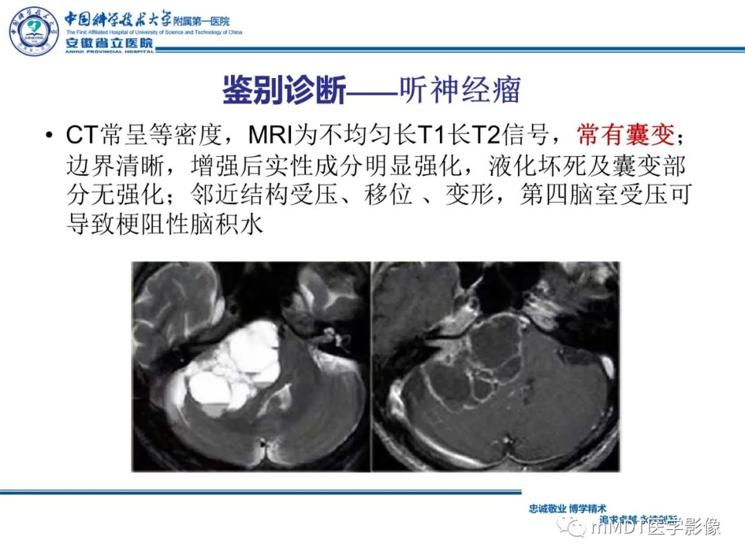 【PPT】毛细胞型星形细胞瘤病例解析-22