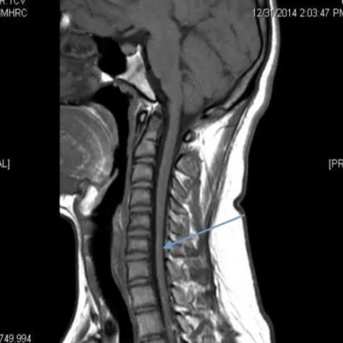 【病例】平山病1例MR影像-2