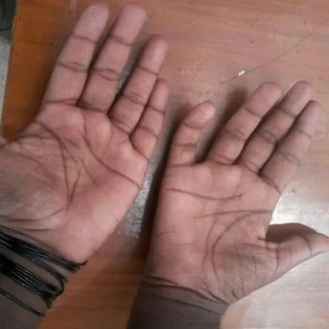 【病例】平山病1例MR影像-1