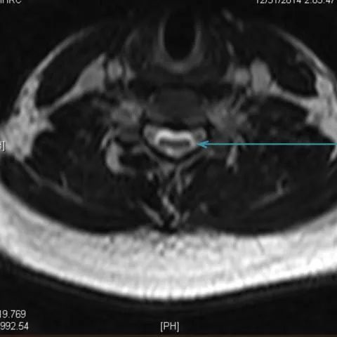 【病例】平山病1例MR影像-5
