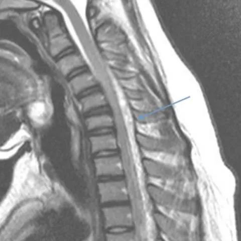 【病例】平山病1例MR影像-4