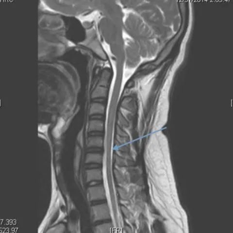 【病例】平山病1例MR影像-3