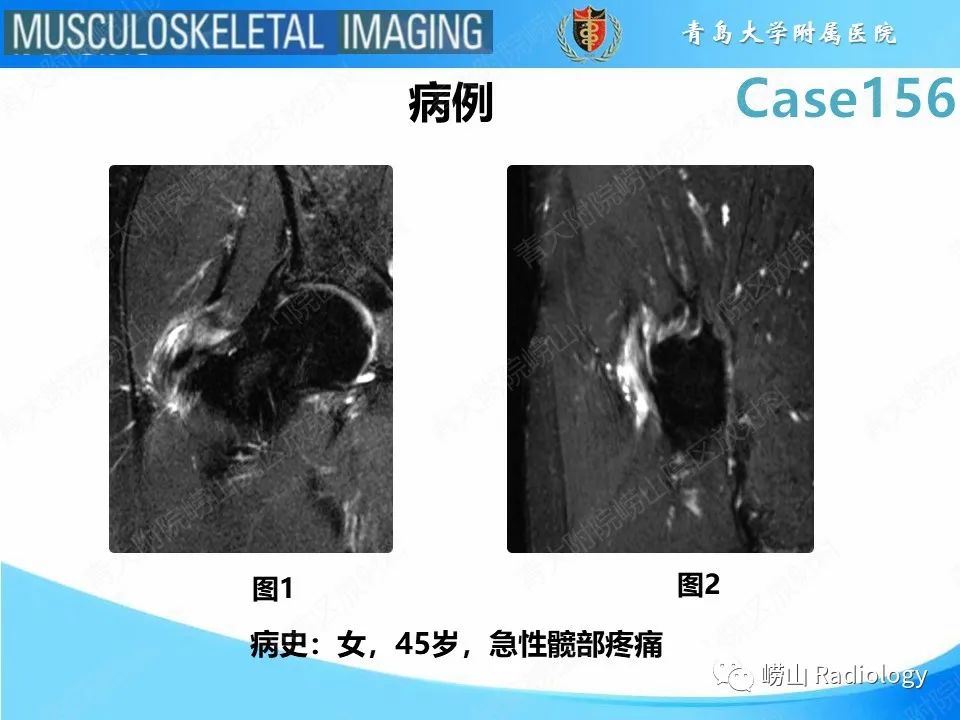 【PPT】臀中肌及臀小肌肌腱撕裂-2