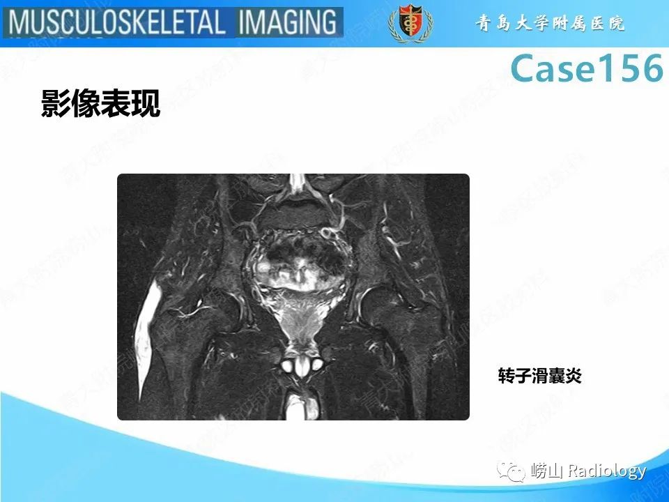 【PPT】臀中肌及臀小肌肌腱撕裂-21