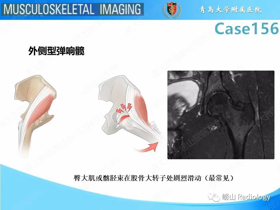 【PPT】臀中肌及臀小肌肌腱撕裂-23