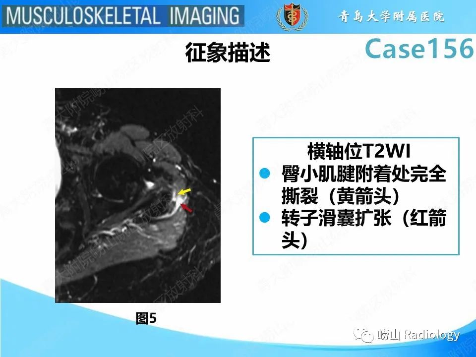 【PPT】臀中肌及臀小肌肌腱撕裂-15