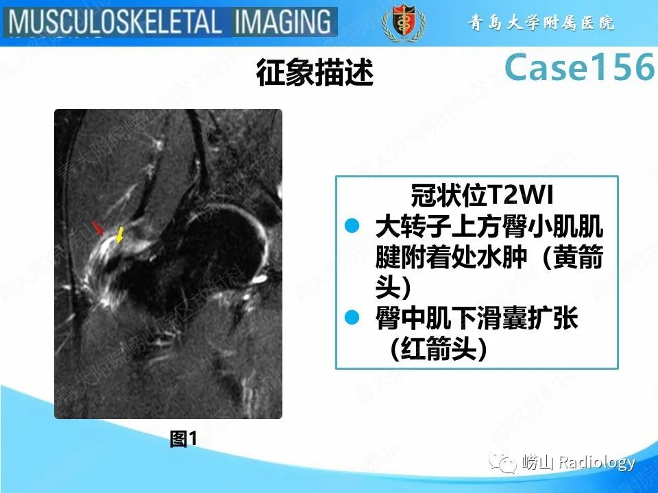 【PPT】臀中肌及臀小肌肌腱撕裂-11