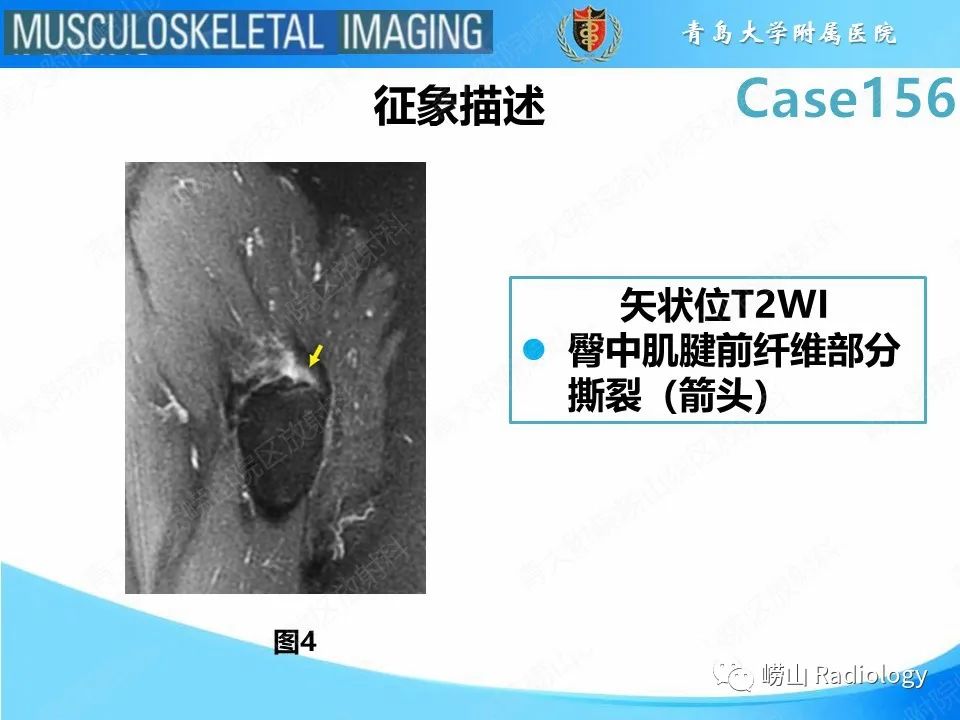 【PPT】臀中肌及臀小肌肌腱撕裂-14