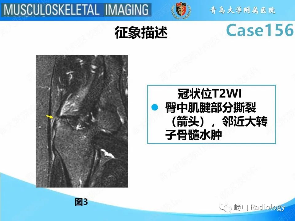 【PPT】臀中肌及臀小肌肌腱撕裂-13