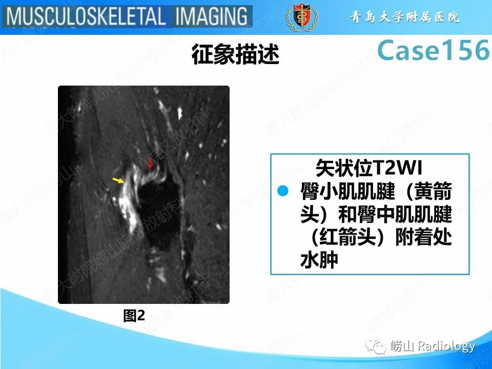 【PPT】臀中肌及臀小肌肌腱撕裂-12